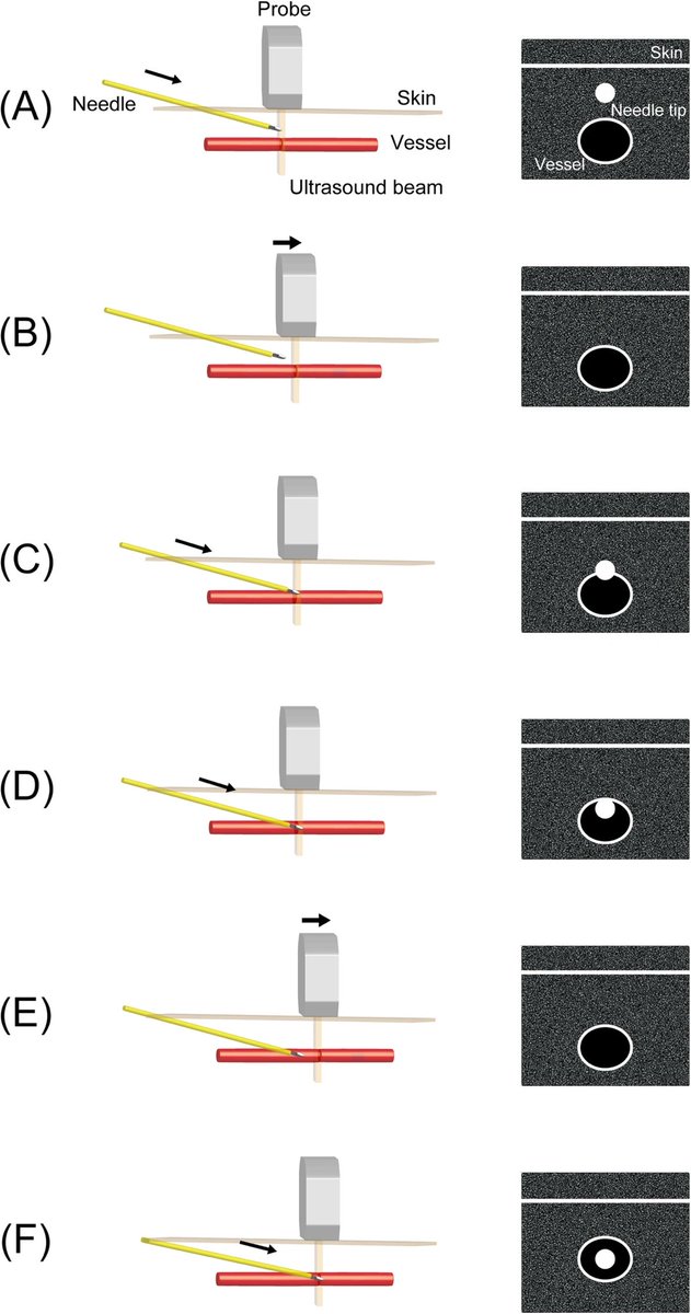 #POCUS guided peripheral vascular catheterization
🔗ccforum.biomedcentral.com/articles/10.11…
#IMPOCUS #FOAMcc #FOAMed
