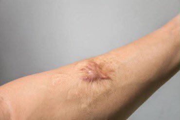 moodtimeline's tweet photo. Treatment menghilangkan bekas luka

- A Thread — https://t.co/q6SUllHm1l