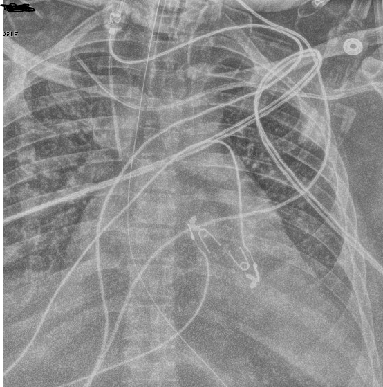 Hassan A. Raza (@hraza222) on Twitter photo Left subclavian CVC placed for vasopressors and it ends up like this. Would you guys retract this or leave it be?
<a href="/IM_Crit_/">IMCrit</a> <a href="/askpocus/">askpocus</a> <a href="/PulmCrit/">𝙟𝙤𝙨𝙝 𝙛𝙖𝙧𝙠𝙖𝙨 💊</a> <a href="/iceman_ex/">Segun Olusanya (He/Him) iceman_ex@critcare.social</a> <a href="/critconcepts/">Critical Concepts</a> <a href="/pulmtoilet/">nick pulmcrit</a> Left subclavian CVC placed for vasopressors and it ends up like this. Would you guys retract this or leave it be?
<a href="/IM_Crit_/">IMCrit</a> <a href="/askpocus/">askpocus</a> <a href="/PulmCrit/">𝙟𝙤𝙨𝙝 𝙛𝙖𝙧𝙠𝙖𝙨 💊</a> <a href="/iceman_ex/">Segun Olusanya (He/Him) iceman_ex@critcare.social</a> <a href="/critconcepts/">Critical Concepts</a> <a href="/pulmtoilet/">nick pulmcrit</a>