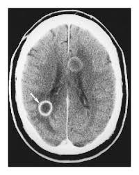 radRounds's tweet photo. Diagnosis? (source: NE JM) https://t.co/CYywDrpwVT