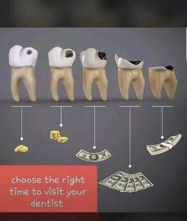 Choosing the right time to visit your Dentist isn’t just a financially smart move but also a good preventive measure. Visit your Dentist at least once every 6 months for your routine check up.
#dentistry #dentaltherapy
