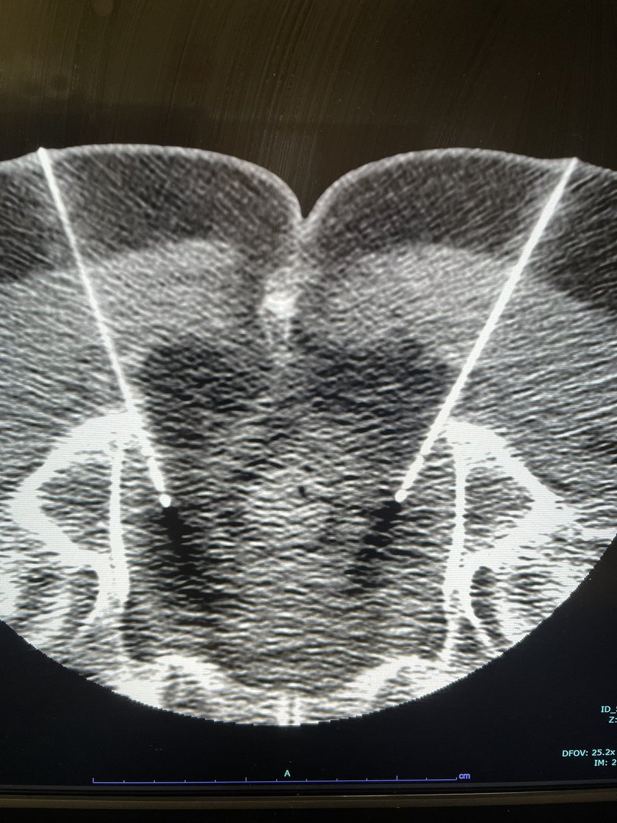 More #MSKIR in an avid cyclist in his 70s who has had perineal pain. His pain responded really well, but temporarily, to pudendal nerve blocks. 

Therefore, bilateral pudendal cryoneurolysis per @jdprologo’s protocol.