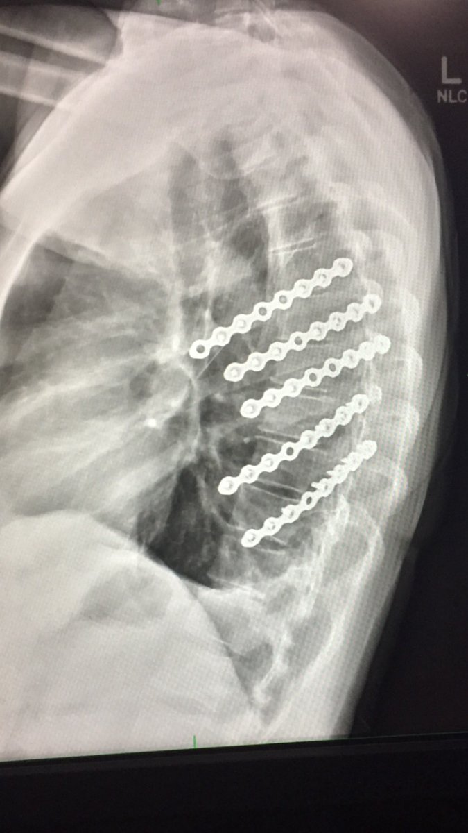 NOGreatResetNO's tweet photo. @NoContextHumans I see #RibPlating is his near future. https://t.co/ml5vuXt8I1