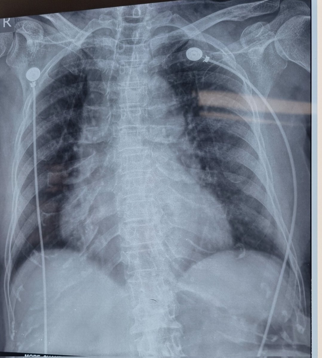 Anything unusual in this cxr of CKD patient??
#MedTwitter
#asknephron
#radiologicalillustration