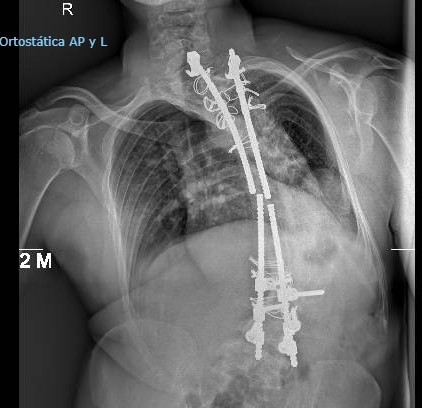 Gabanio's tweet photo. @garciaespino7 Tengo hecha una operación similar pero hace 22 años, tenía 66° de cifoescoliosis... Ojalá me la hubiese hecho ahora la verdad, mucho ánimo 🍀 https://t.co/iQ8vLT2bod