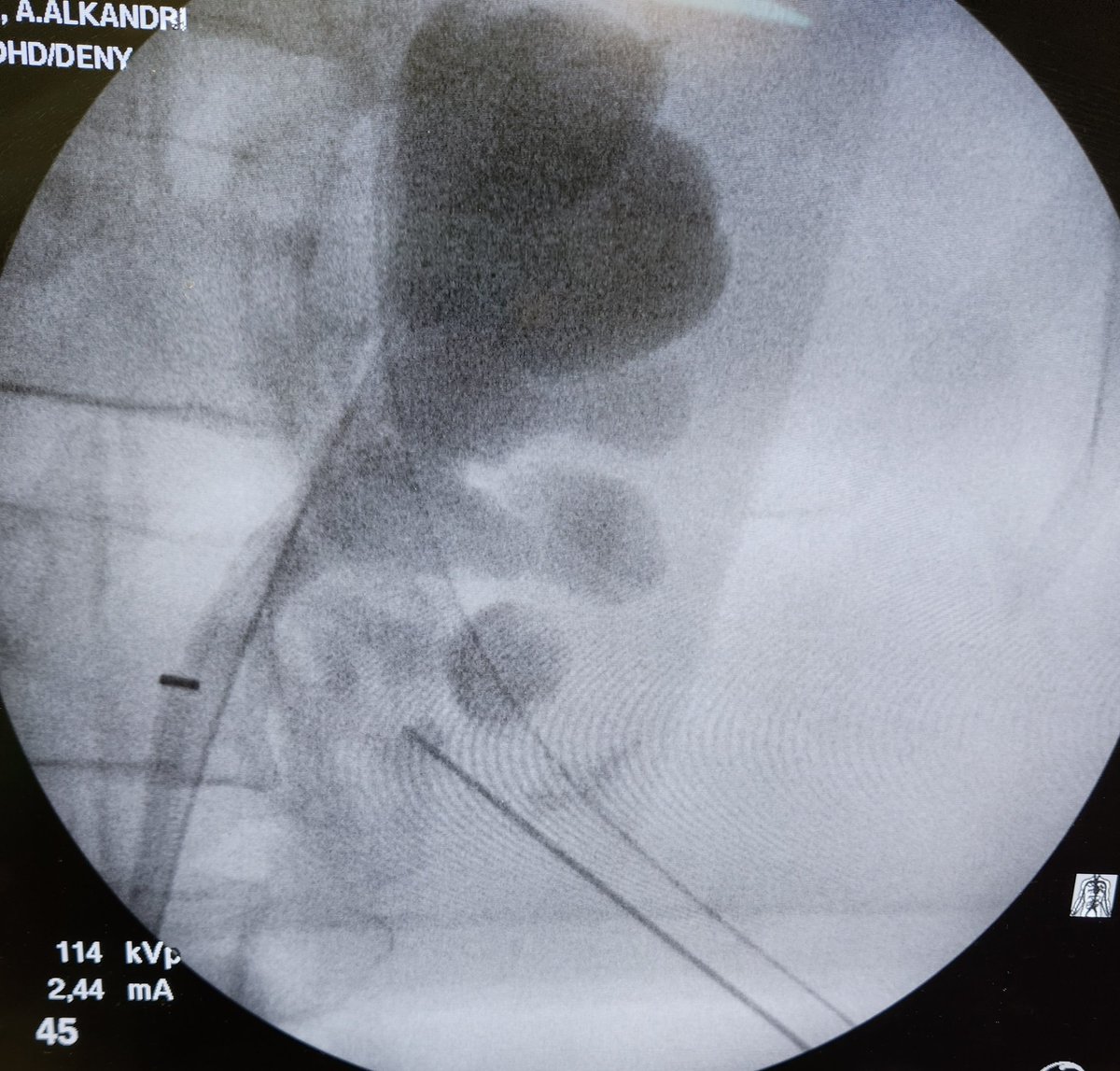 DRAAA86's tweet photo. 🔴 #supinr_PCNL
🔴2 punctures + flexible
To have best #stone_free
Nice approach for redo-cases https://t.co/XJaPW2uNgA
