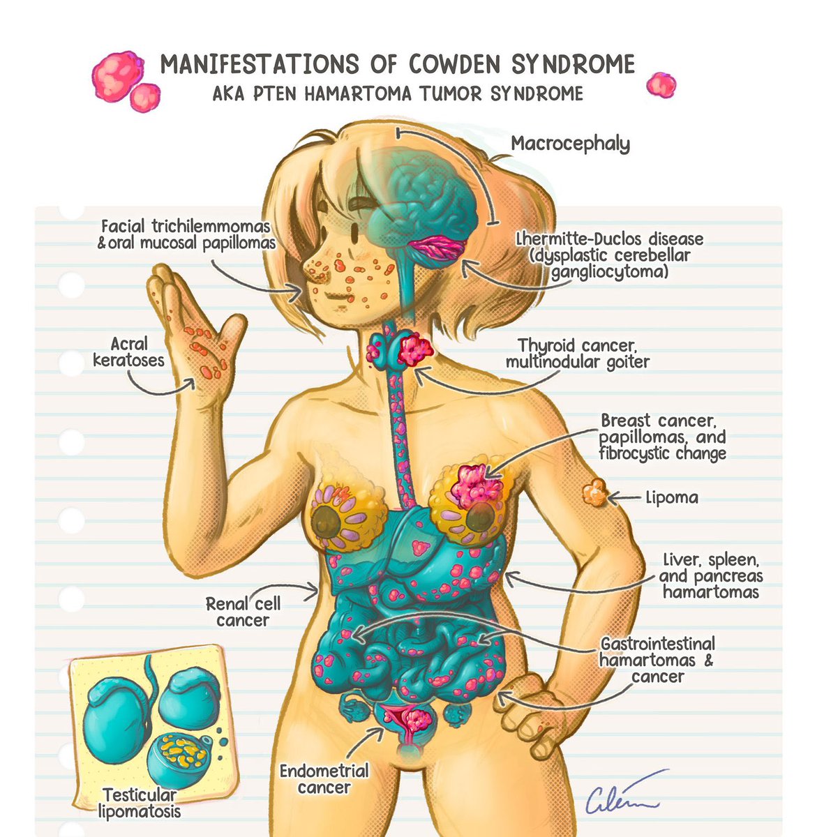 Cowden syndrome <a href="/artibiotics/">Ciléin Kearns</a> #Medtwitter (pubs.rsna.org/doi/10.1148/rg…)
