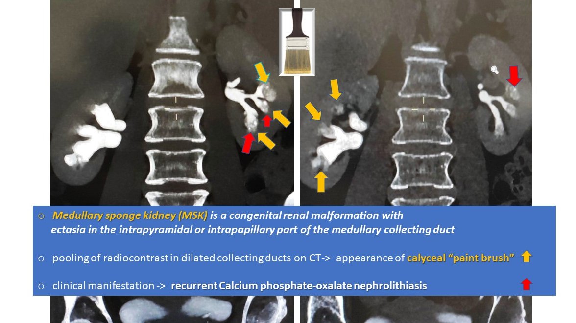 Pierpaolo Di Nicolò on Twitter "nephpearls nephrology radiology 