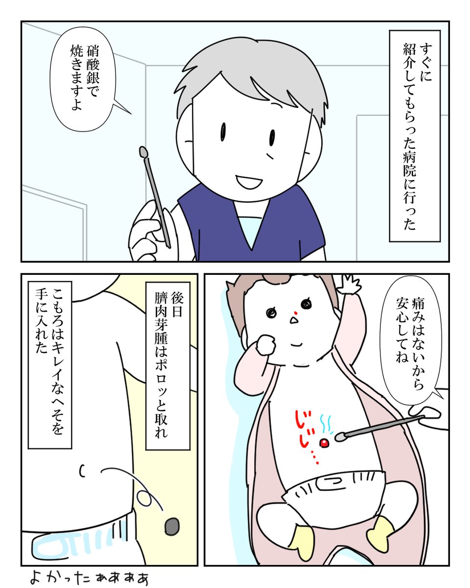 臍ヘルニアだと思ったら「臍肉芽腫」だった話 4/4 