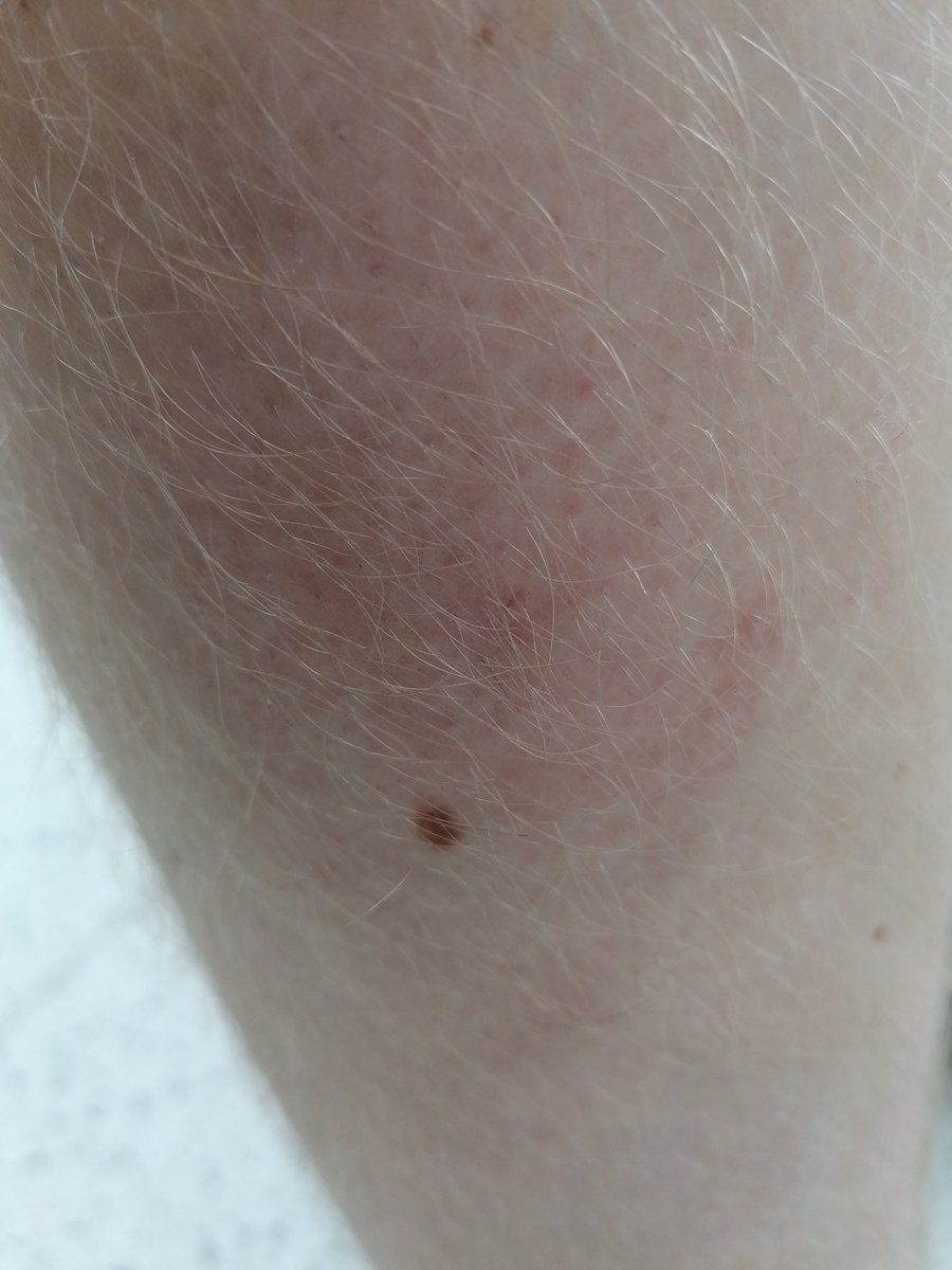 Was stranding in a crosswind. And a wasp litterally flew needle first into My leg https://t.co/EPLBGfWhGx