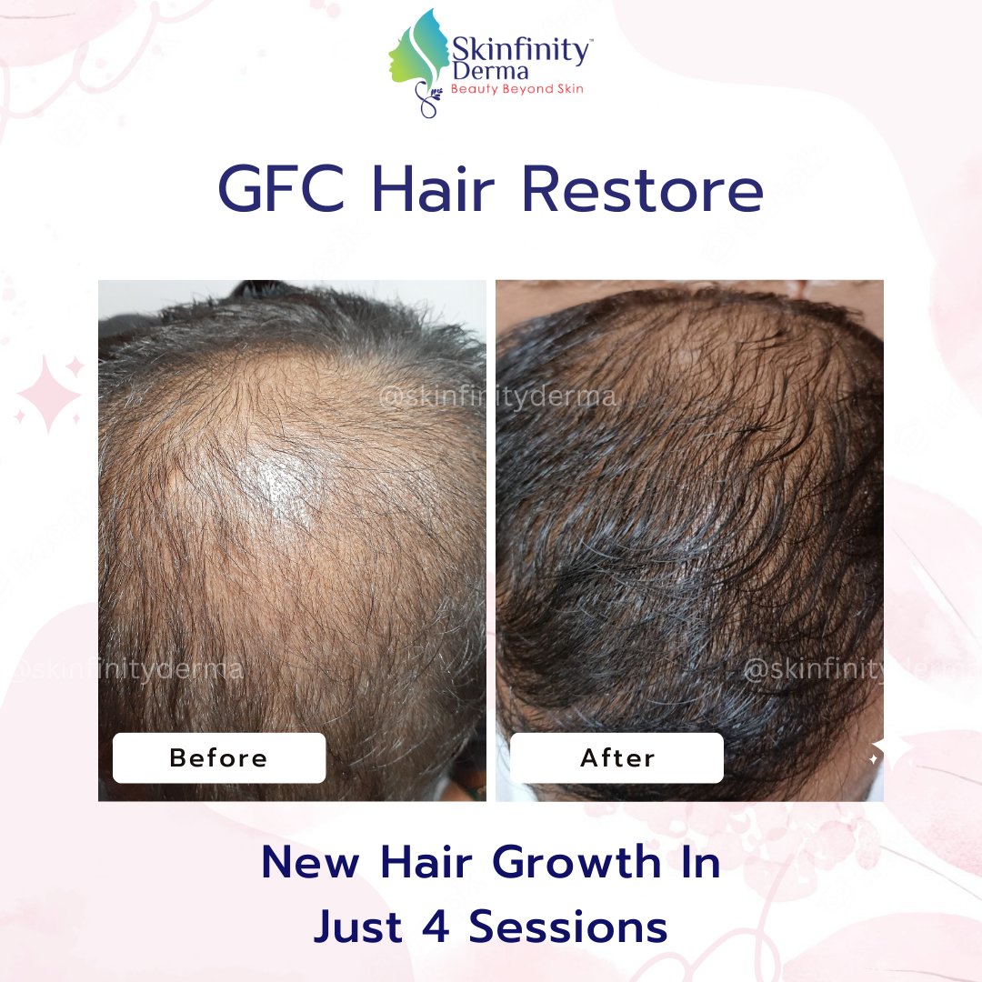 Witness the Hair Transformation! Client's Before and After in just 4 sessions with our revolutionary GFC Hair Treatment
#dripshitajohri #skinfinityderma #gfc #gfctreatment #beforeafter #hair #hairfall #hairfallsolution #dermatologist #skincare #hairspecialists #haircareroutine