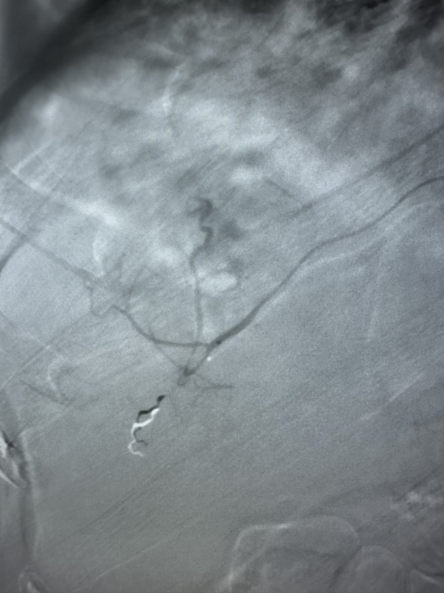 AustinBourgeois's tweet photo. Small residual focus of cholangiocarcinoma on  FDG PET following #radseg.  

Repeated the mapping and found a branch of the right inferior phrenic supplying the poster margin of the mass. Flow diverted with a 1 mm coil, and treated at 1100Gy.  

#stayvigilant
#iRad https://t.co/8YoBzQCnvc