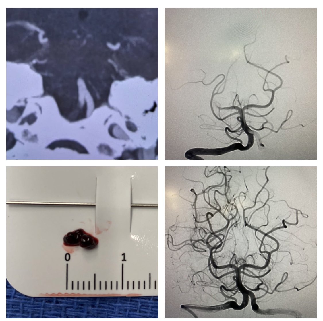 JanKarlBurkhar1's tweet photo. And 3 for 3 #TICI3 #Firstpass for another PCA occlusion within last 10d. This time symptomatic R V4 occlusion migrated after #TNK to R PCA. @PennNSG #stroke @cvsection #Rist079 #Red62 #Aristotle24 https://t.co/ezH4r6n2sq