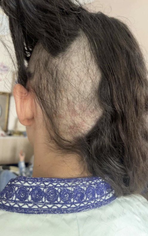 CerfiaFR's tweet image. 🇫🇷 FLASH | Camélia, âgée de 12 ans, subit depuis un an du harcèlement scolaire à #HerblaySurSeine. « T'es moche, t'es une p*te, clocharde, …».

Elle est victime d'insultes, de moqueries sur son physique et de violences. Ce harcèlement a entraîné chez elle un état de…