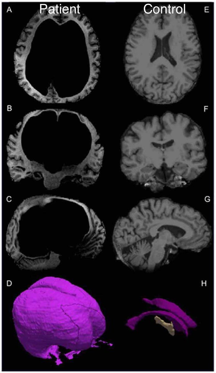 OGdukeneurosurg's tweet photo. The Adaptable Brain: 60 yo male went to psych for an assessment of depression &amp; discovered he’d lived his whole life w/ only a very thin rim of brain and mostly a skull filled with cerebrospinal fluid. https://t.co/1wI2AtkTKm