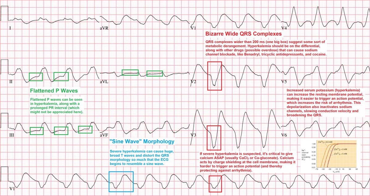 @EM_RESUS Young woman s/p resus after cardiac arrest. My interpretation: 🔴 Bizarre Wide QRS Complexes 🔵 'Sine Wave' Morphology 🟢 Flattened P Waves DDx: Hyperkalemia, metabolic derangement, drug overdose (cocaine, TCAs, Benadryl)? Tx: Calcium (CaCl₂)