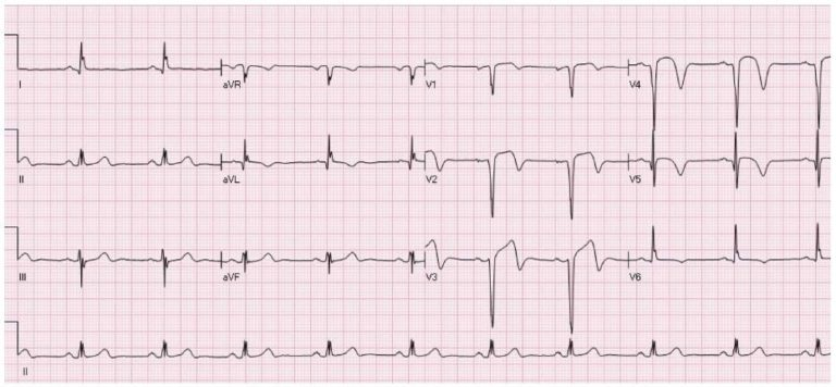 SUNDAY QUESTION: A 35-year-old previously healthy male presents to the emergency department (ED) complaining of chest pain and breathlessness following an unknown bite. On arrival, he is conscious and alert, tachypneic with normal SpO2, heart rate and blood pressure. (1/2)🧵