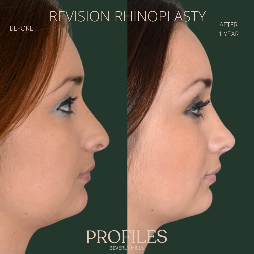 FacialPlastics's tweet photo. 📞310-276-6800
🏠 435 N Bedford Drive, PH500, Beverly Hills, 90210
👃Revision Rhinoplasty
🗓 Before and After 1 Year
🛏 About 1 week, the cast gets taken off after 6 days

Swipe ⏩⏩⏩ for more views

A high deviation of the septum caused this patient to have a f... https://t.co/jwW7iFOnLW