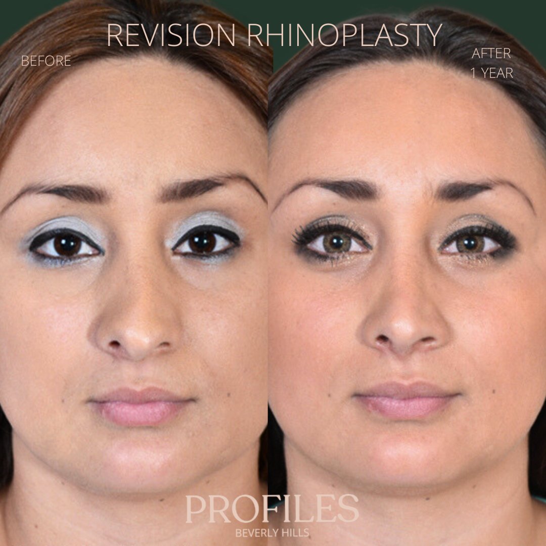 FacialPlastics's tweet photo. 📞310-276-6800
🏠 435 N Bedford Drive, PH500, Beverly Hills, 90210
👃Revision Rhinoplasty
🗓 Before and After 1 Year
🛏 About 1 week, the cast gets taken off after 6 days

Swipe ⏩⏩⏩ for more views

A high deviation of the septum caused this patient to have a f... https://t.co/jwW7iFOnLW