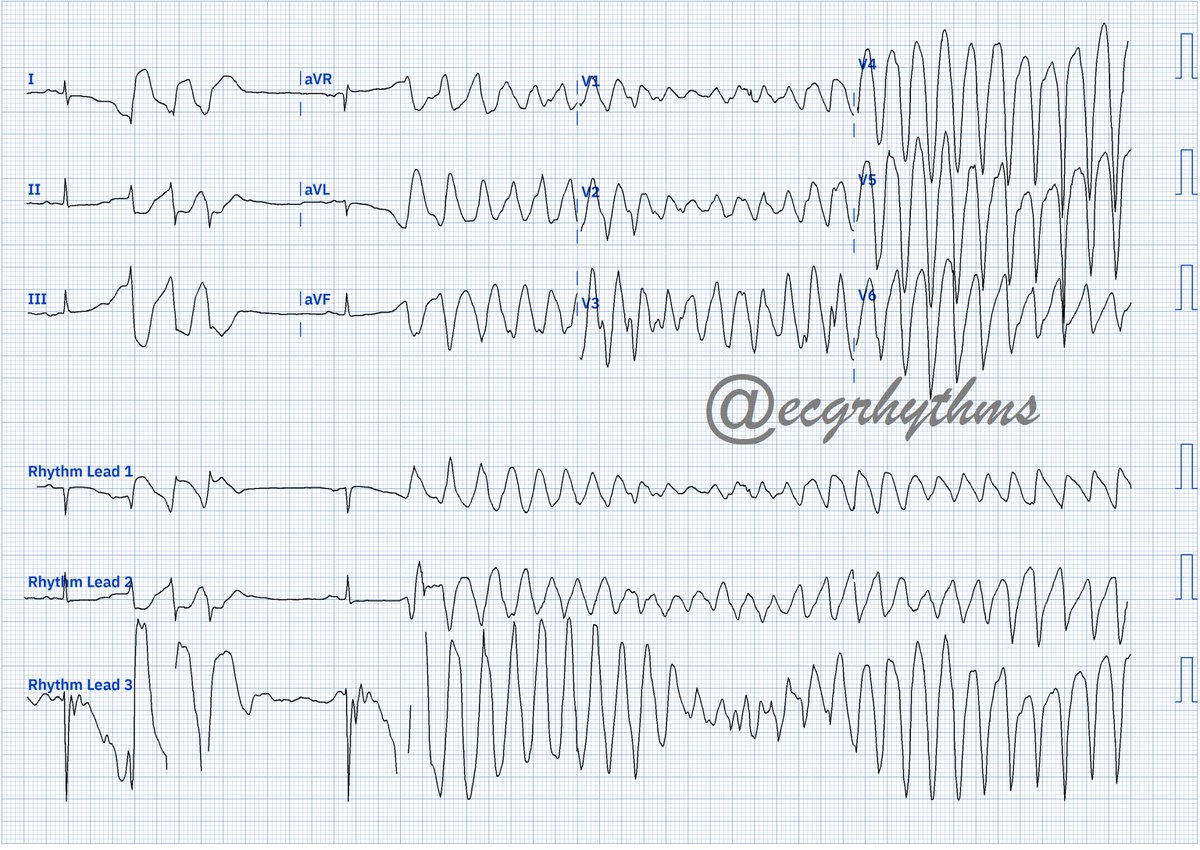 ecgrhythms's tweet photo. 071623
From the📦/📧 by a 🫂
#BasicECG
Difficulty level (out of 5⭐️): ⭐️
Digitized using @pmcardiobot
What is your ECG interpretation?
#MedEd
#MedTwitter
#CardioTwitter
#EPeeps https://t.co/94ovdEdNHe