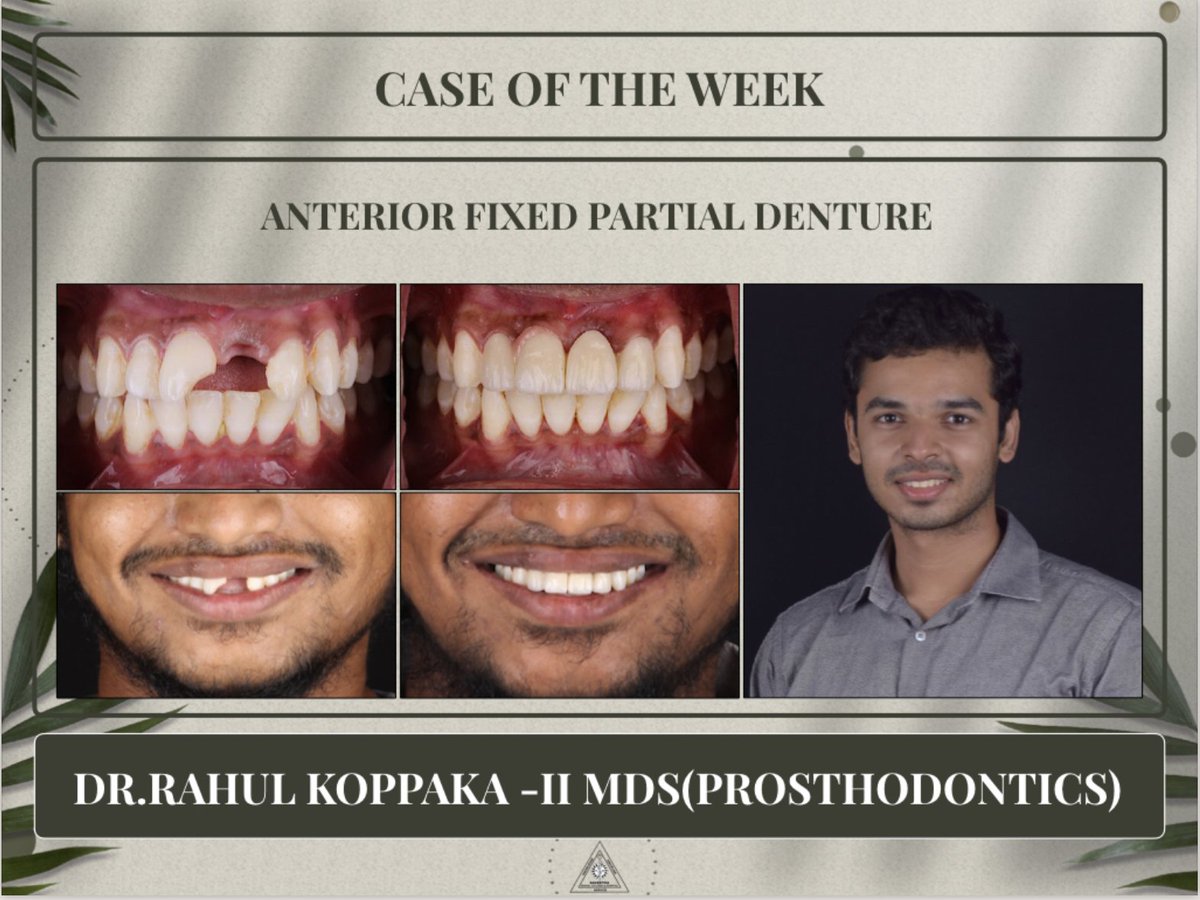 Case of the week - Anterior Fixed Partial Denture #dentistry #teeth #dentalcare