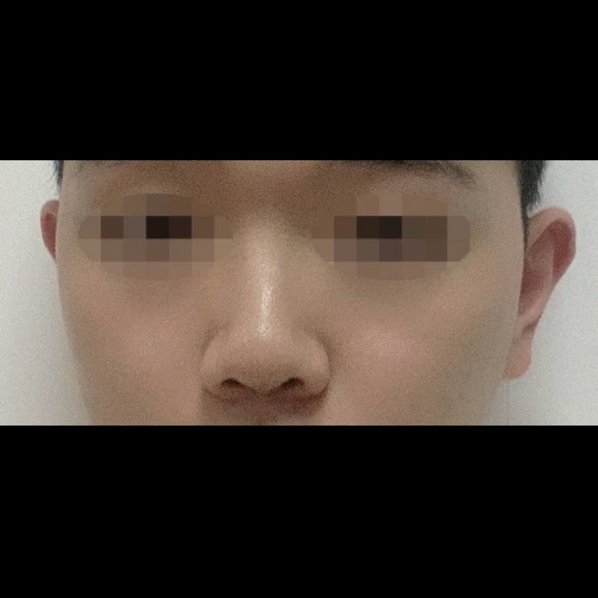 jayjun_jpn's tweet image. 鼻整形 🫧 体験談
鼻が短くて、鼻先が上がっていたのが悩みでした。
手術してから2か月が経ちますが、鼻のラインが徐々に整ってきている気がします。
キム・ヒョンロク医院長のカウンセリングでは必要な手術だけを勧めてくださったので、とても良かったです！

#jayjun #美容垢 #メンズ #鼻整形