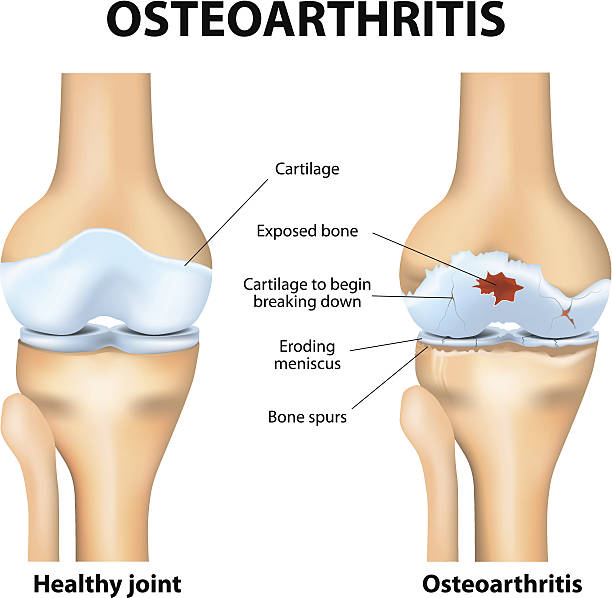PhysioTweed's tweet photo. OSTEOARTHRITIS is the most common form of arthritis. Some people call it degenerative joint disease or wear &amp; tear arthritis. It occurs most frequently in the hands, hips &amp; knees. With OA, the cartilage within a joint begins to break down &amp; the underlying bone begins to change. https://t.co/JUUm3EY8c5