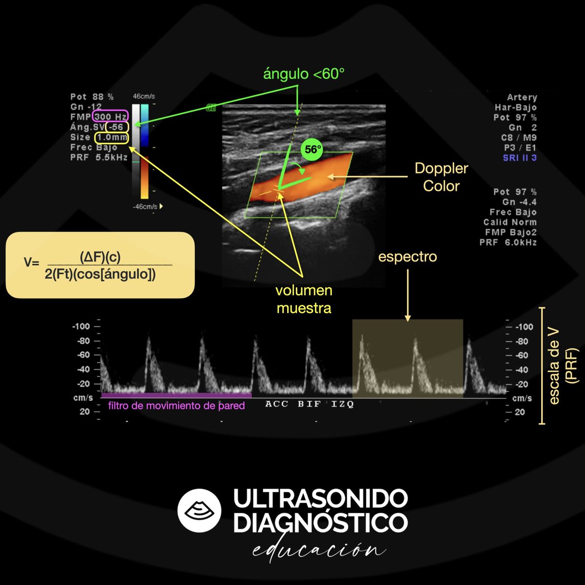 No tienen idea de la cantidad de estudios que veo donde no corrigen electrónicamente el ángulo para hacer el cálculo de la velocidad.

Aquí te dejo lo mínimo indispensable que debe llevar tu imagen triplex.

#ultrasonido #doppler #radiologia