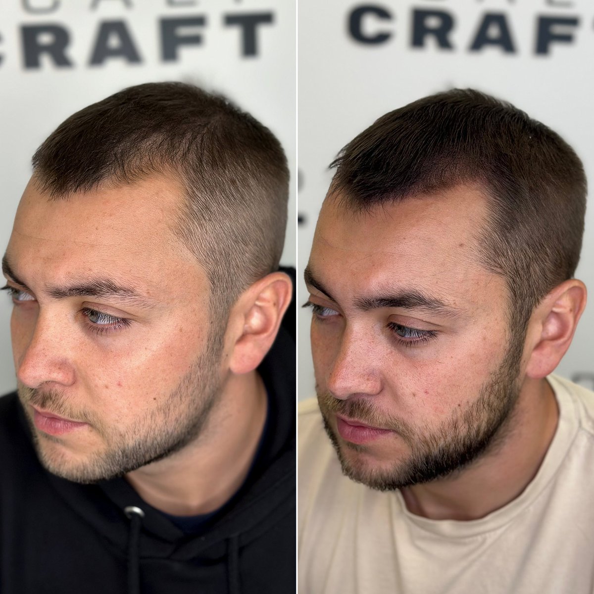 SCALPCRAFT's tweet image. 𝘽𝙀𝙁𝙊𝙍𝙀/𝘼𝙁𝙏𝙀𝙍: Scalp Micro-Pigmentation density treatment. 

This works very well for guys who are thinning and want to give the illusion of thicker and fuller hair. 

Swipe through to see the difference made 🔥

🖥️ scalpcraft.co.uk
❇️ 07300 845 866…