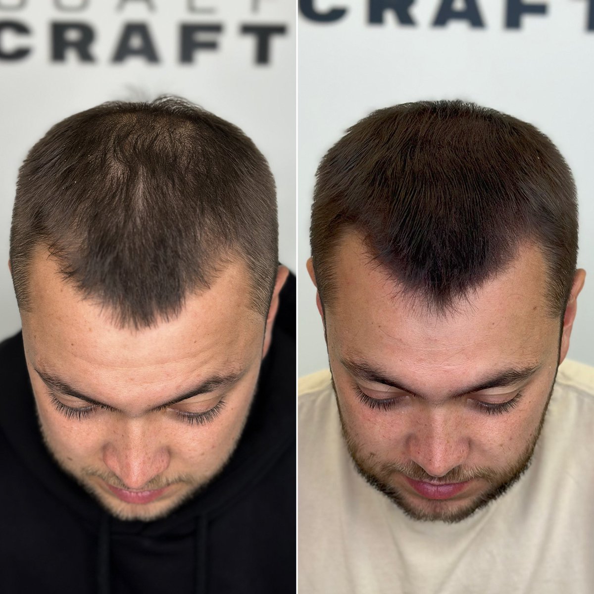 SCALPCRAFT's tweet image. 𝘽𝙀𝙁𝙊𝙍𝙀/𝘼𝙁𝙏𝙀𝙍: Scalp Micro-Pigmentation density treatment. 

This works very well for guys who are thinning and want to give the illusion of thicker and fuller hair. 

Swipe through to see the difference made 🔥

🖥️ scalpcraft.co.uk
❇️ 07300 845 866…
