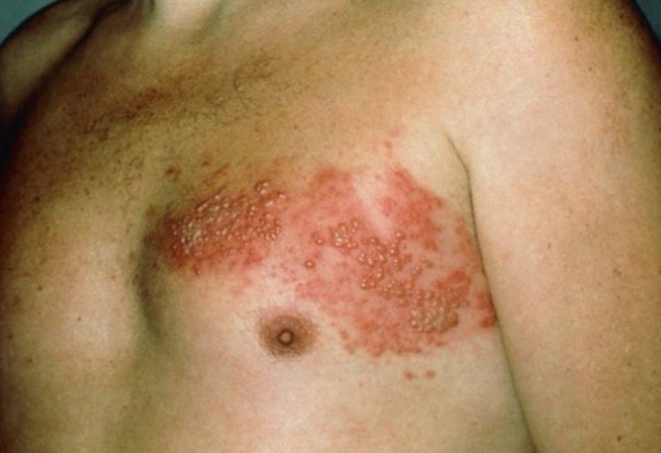 Recurrent, painful lesions in the same area. Diagnosis? #MedTwitter