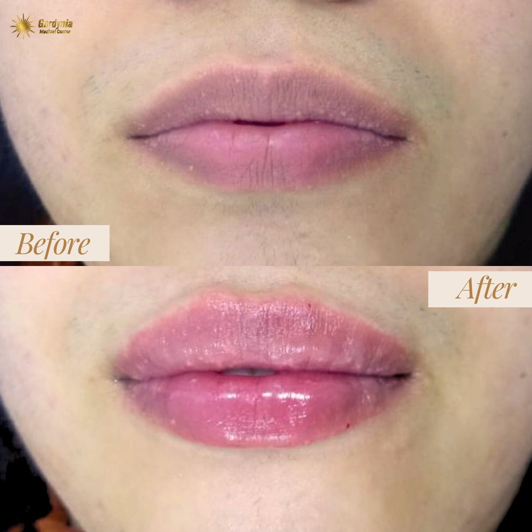 Been wanting to have that plump lips? Try our Lips Filler procedure now. Send us a message to inquire.😍✨

#gardyniacenter #gardyniaclinc #lipsfiller #lips #newlips #russianlips #lipsaugmentation #perfectlips #lipsfillerdubai #dubaibeauty #beauty #dubaibeautyclinic #beautyclinic
