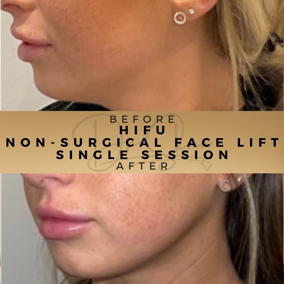 Before & After

#NonSurgical #NonSurgicalTreatments #FacialAesthetics #FaceLift #BeforeandAfter #NonsurgicalFacelift #HIFUTreatment #SkinTightening #AgeDefying #NoSurgeryNeeded #HIFUFacelift #AntiAgingTreatment #HIFUSkinLifting #FaceliftWithoutSurgery #HIFUTherapy #DrSknn