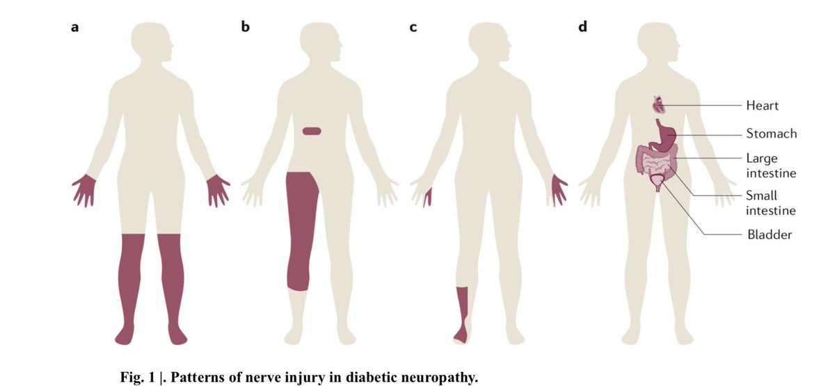 TDekkersPhysio's tweet photo. Are you up to speed on how to recognise a diabetic neuropathy?

Main signs:
👉Pain, numbness, tingling, weakness &amp; unsteadiness 
👉‘Stocking &amp; glove’ distribution but more common in 🦶 
👉Symptoms start distally > proximally 
👉Loss of ankle reflex

https://t.co/DqGI8D6j7K https://t.co/o7l2QMC0Kx