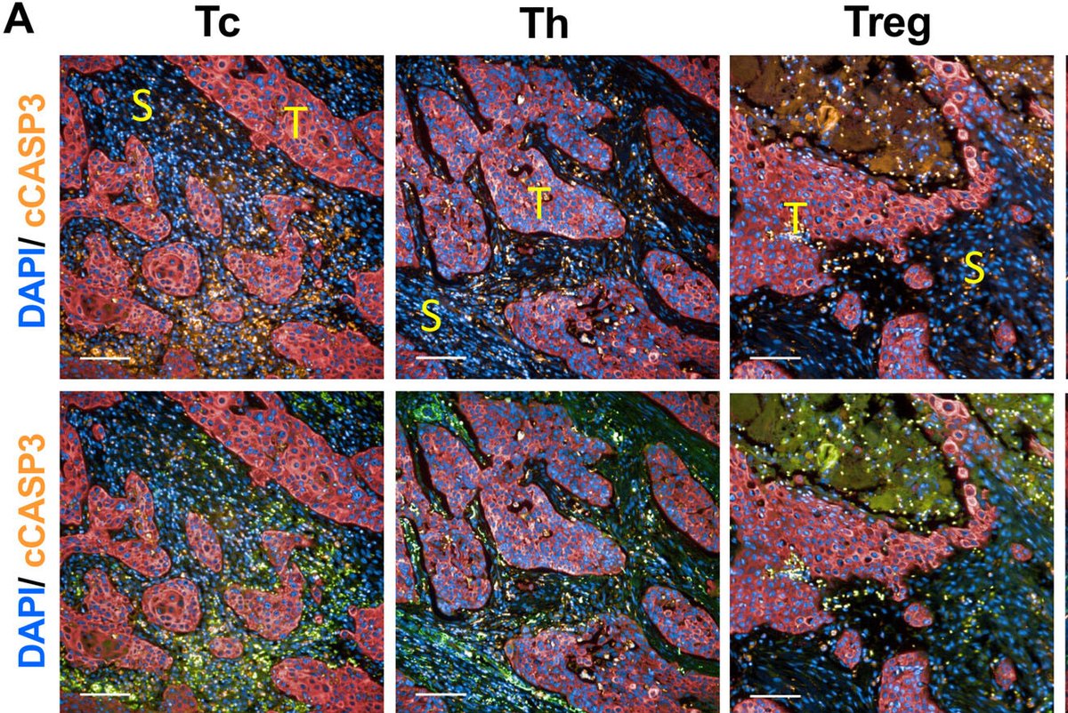 KCLstemcells's tweet photo. 📢 Just published! An exciting study from #wattlab by @drPriyankaB_ reveals that despite the immune-rich microenvironment, OSCC exhibits resistance to apoptosis. Instead, the toxic tumor environment induces apoptosis in lymphocytes. Check out full story👇
https://t.co/c0g0yVEk9e https://t.co/cbOiD6xYA5
