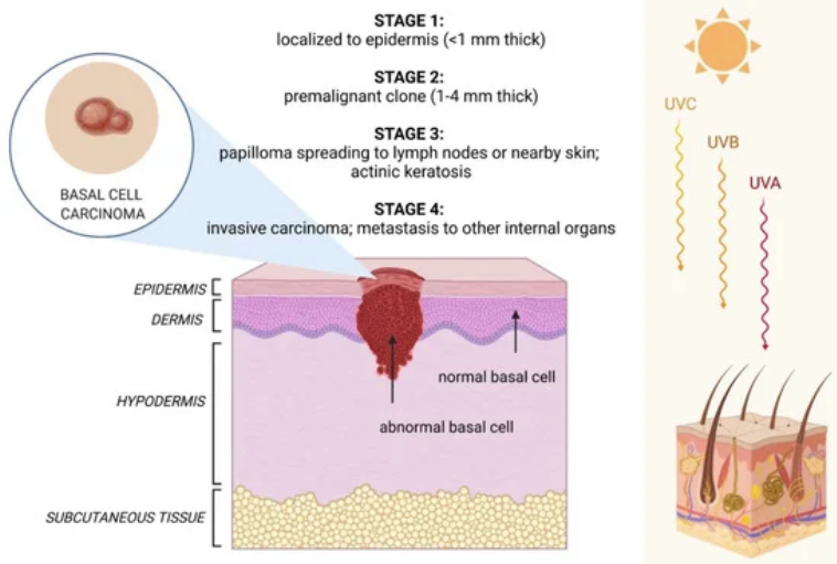 Studying Medicine on Twitter "Basal cell skin carcinoma low