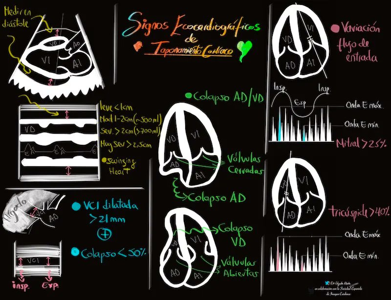 ImagenCardiaca's tweet photo. Senos del pericardio
Repaso de las infografías de Alania 
📊 https://t.co/C623Ze5qKW ◀️ https://t.co/S92tK2NOps