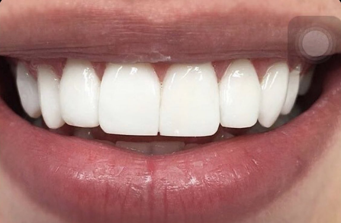 Si tuviera estos dientes hasta lloro sonriendo.