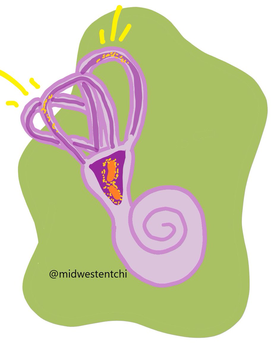 Benign paroxysmal positional vertigo (BPPV) occurs when particles from the vestibular organ become trapped in the inner ear structures that control balance. This causes dizziness which feels as if the room is spinning. This type of dizziness is triggered by changes in position.