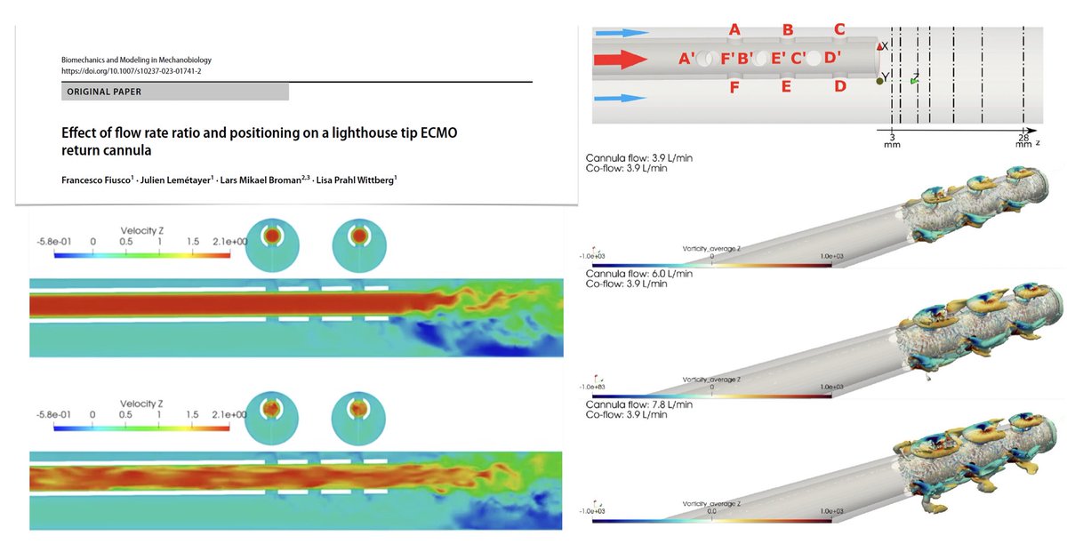M Velia Antonini (@foamecmo) on Twitter photo Effect of flow & position on lighthouse tip #ECMO return cannula:
🩸tilted cannula reinfused larger amount of fluid through side holes on narrow side vs wide, but fraction of reinfused fluid not influenced by flow rate ratio
🩸small recirculating vortexes developed on narrow Effect of flow & position on lighthouse tip #ECMO return cannula:
🩸tilted cannula reinfused larger amount of fluid through side holes on narrow side vs wide, but fraction of reinfused fluid not influenced by flow rate ratio
🩸small recirculating vortexes developed on narrow