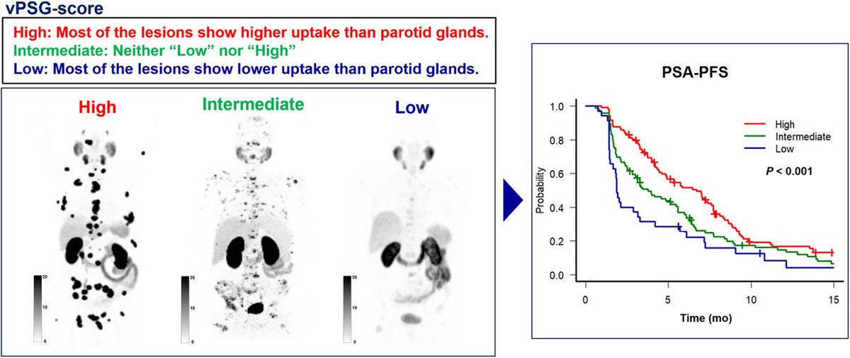JNM (@journalofnucmed) on Twitter photo JNM Manuscript of the Month: PSMA PET Tumor–to–Salivary Gland Ratio to Predict Response to ¹⁷⁷Lu-PSMA Radioligand Therapy: An International Multicenter Retrospective Study. ow.ly/7kzT50P3Xh2
#NuclearMedicine #ProstateCancer <a href="/CalaisJeremie/">Jeremie Calais</a> <a href="/masatoshihotta/">Masatoshi Hotta</a> JNM Manuscript of the Month: PSMA PET Tumor–to–Salivary Gland Ratio to Predict Response to ¹⁷⁷Lu-PSMA Radioligand Therapy: An International Multicenter Retrospective Study. ow.ly/7kzT50P3Xh2
#NuclearMedicine #ProstateCancer <a href="/CalaisJeremie/">Jeremie Calais</a> <a href="/masatoshihotta/">Masatoshi Hotta</a>