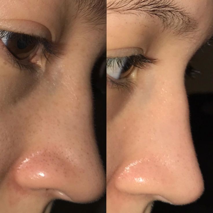 zaiquzai's tweet photo. How I finally removed blackhead on my nose https://t.co/FTg2f0B2ts