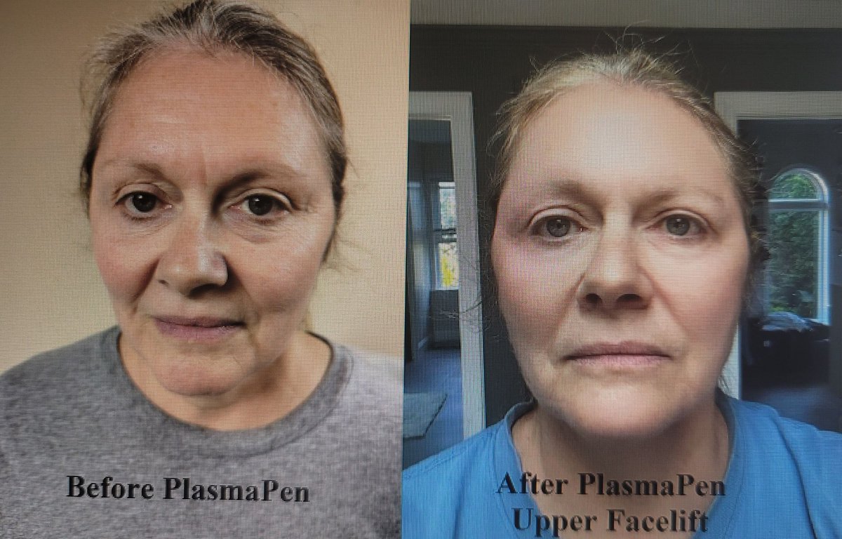 Results of partial face lift with PlasmaPen <a href="/TranslateNurSpa/">Translate Nursing Med Spa</a> #medspa #translatenursing #skincare