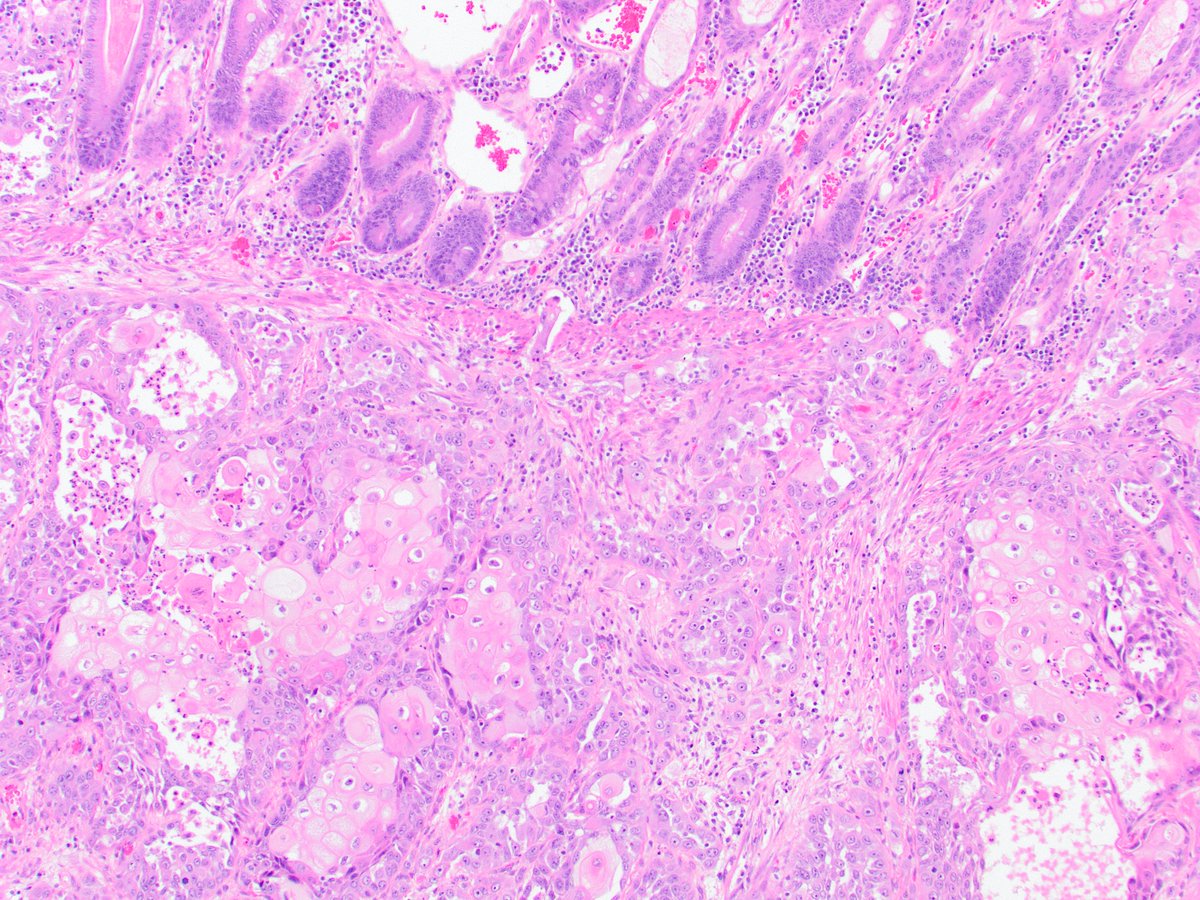 Do you have a case of primary colorectal squamous cell carcinoma? I'm putting together a cohort. If you definitely have a case (primary elsewhere excluded), please get in touch and I'll send info. Would be great to include it (and you) in my study! #pathology #PathTwitter #gipath
