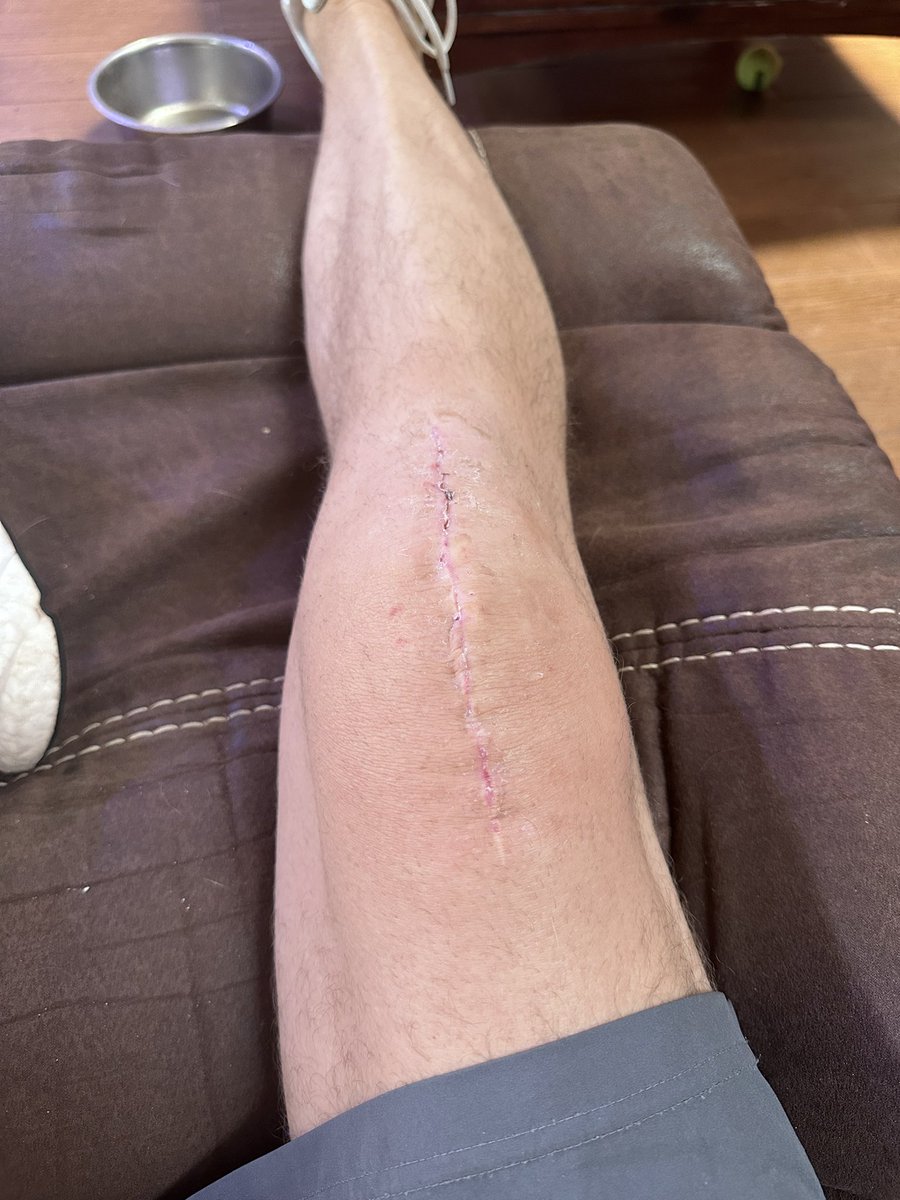 palanmat's tweet image. 1 month post knee replacement.  Healing nicely and mobility is coming quicker by the day.  Incredibly happy with the results and close to being ready for replacement on the other knee.  #oldpeopleproblems