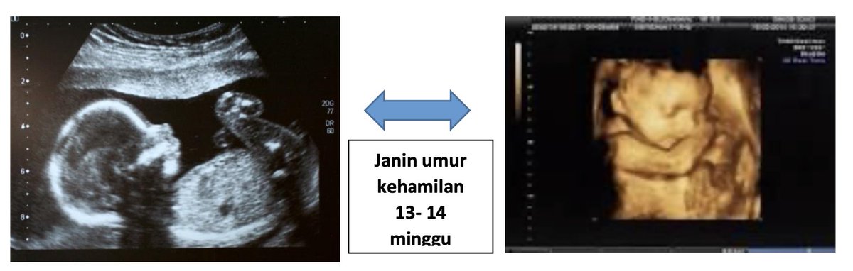 ABORSI ( Draft RUU Komisi IX DPR RI )

1. Pasal 60 ayat 1

 Setiap orang yang melakukan aborsi, kecuali dengan kriteria yang  diperbolehkan sesuai dengan ketentuan dalam kitab undang-undang hukum pidana.

KUHP 2023, Bagian 2, Aborsi, pasal 463

(1)  Setiap perempuan yang