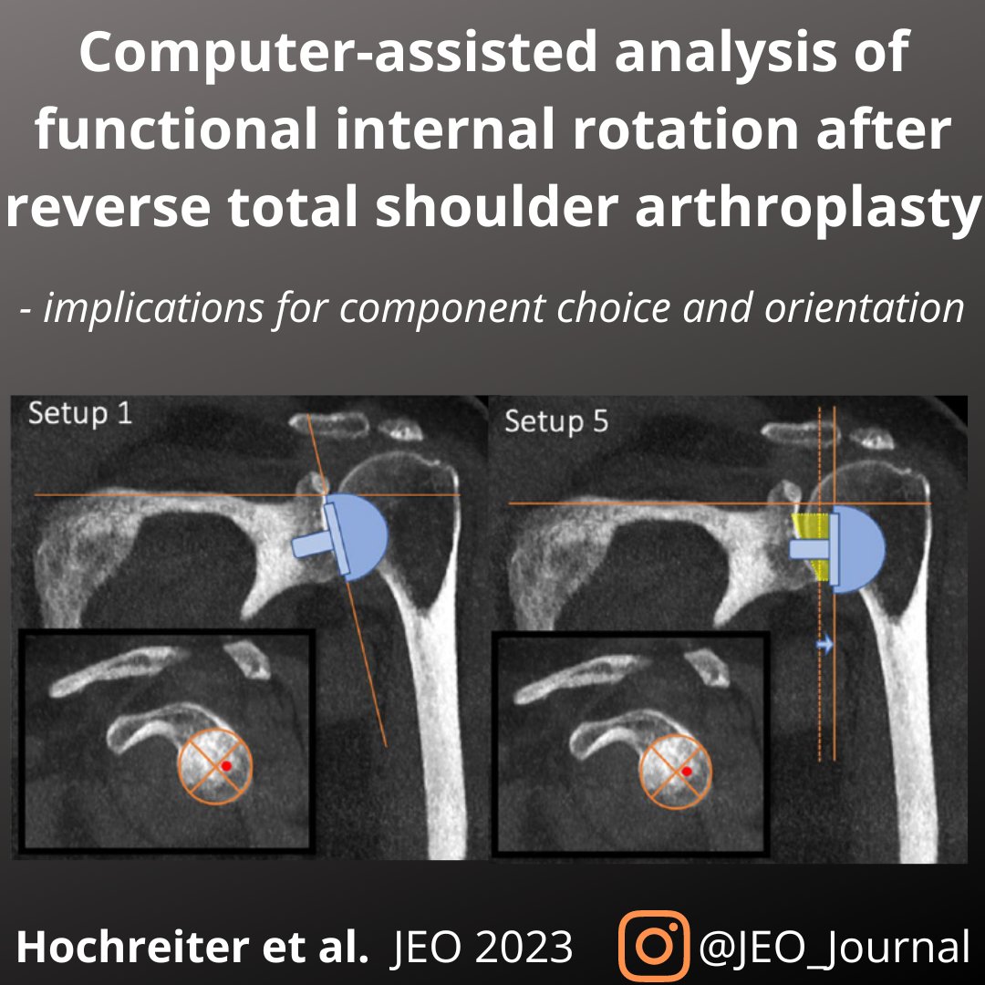 JEO_journal's tweet photo. Functional internal rotation (IR), a combination of extension and IR, is clinically often limited after reverse total shoulder arthroplasty.
How to avoid it?Let's take a look at this OPEN ACCESS article: https://t.co/MatumUiBZi
#RTSA #internalrotation #reversetotalshoulder https://t.co/mEz6B1vHfu