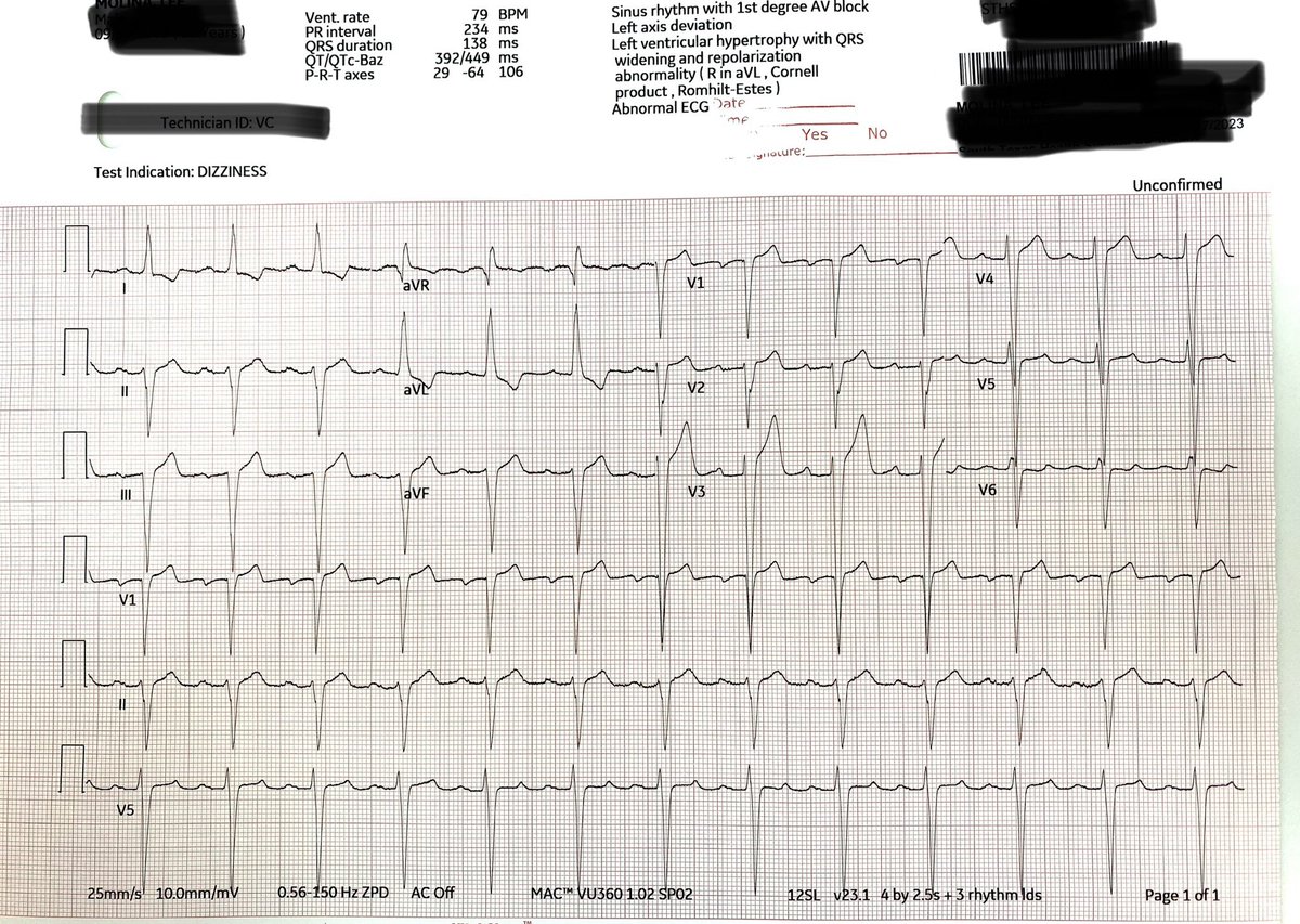 ⁦<a href="/smithECGBlog/">Stephen W. Smith</a>⁩ 

The 4-variable score I get is: 22.8 !!
cQT: 449
QRS V2: 14 mm
R V4: 6 mm
ST-J in V3: 3 mm

I’d much appreciate any thoughts or corrections on plotting this numbers.