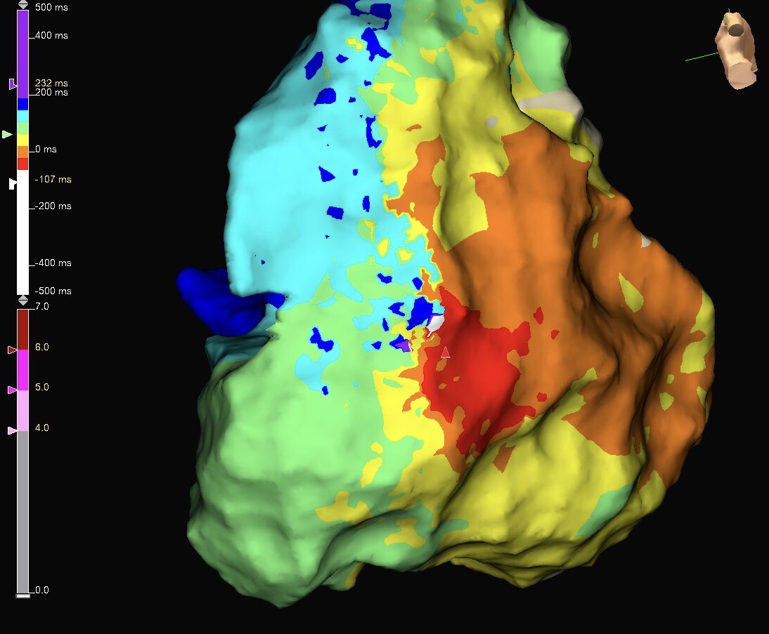 richardjdobson1's tweet photo. Ischaemic cardiomyopathy with incessant VT mapped by @AlexandriaSaban Beautiful definition of isthmus and ablated to sinus in #oneburnterm @ProfDConnelly @JubileeHospital @AbbottCardio #HDGrid #EnsiteX https://t.co/MdapVnGgPW