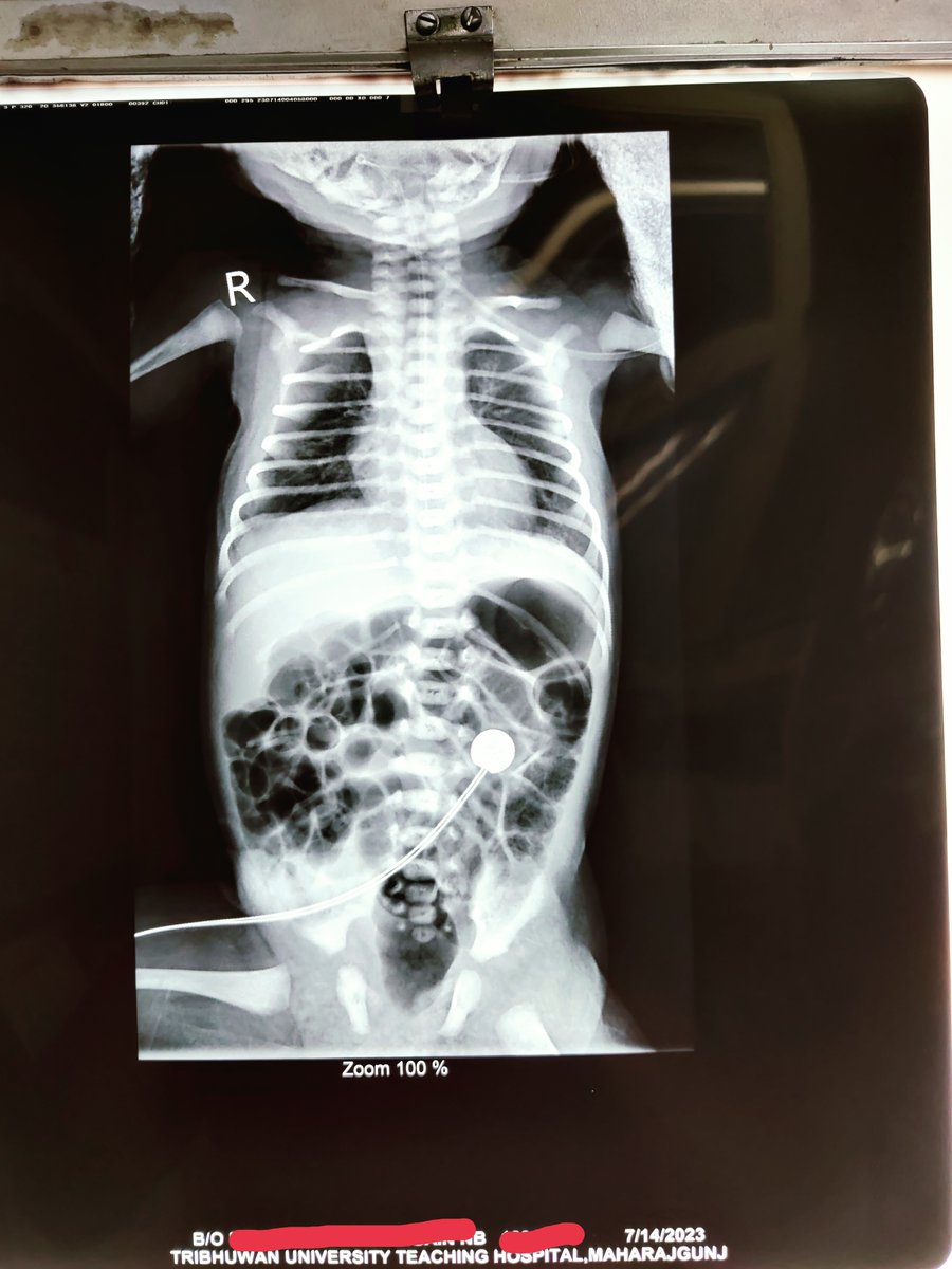 🧵Thread: Miracle and challenges of Modern Medicine
1/5 📸 This pair of X-ray photos shows the same infant photographed both before and after receiving surfactant therapy. 
Surfactant is truly a miracle drug that aids these tiny fighters in breathing. #MedTwitter #RDS #Preterm